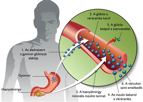 Az 1-es típusú cukorbetegség infografikája
