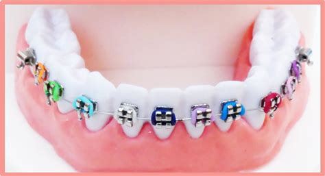 Bracket eltávolítása