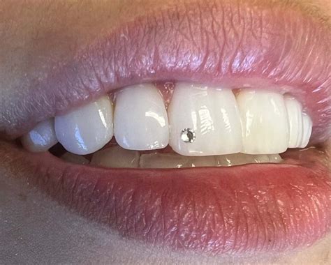 Fogékszer felhelyezése