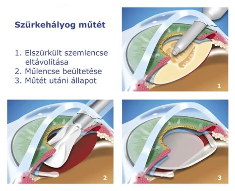 Turbócsövek eltávolítása utáni állapot