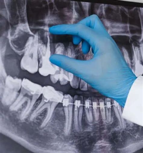 Zárókupakok Eltávolítása